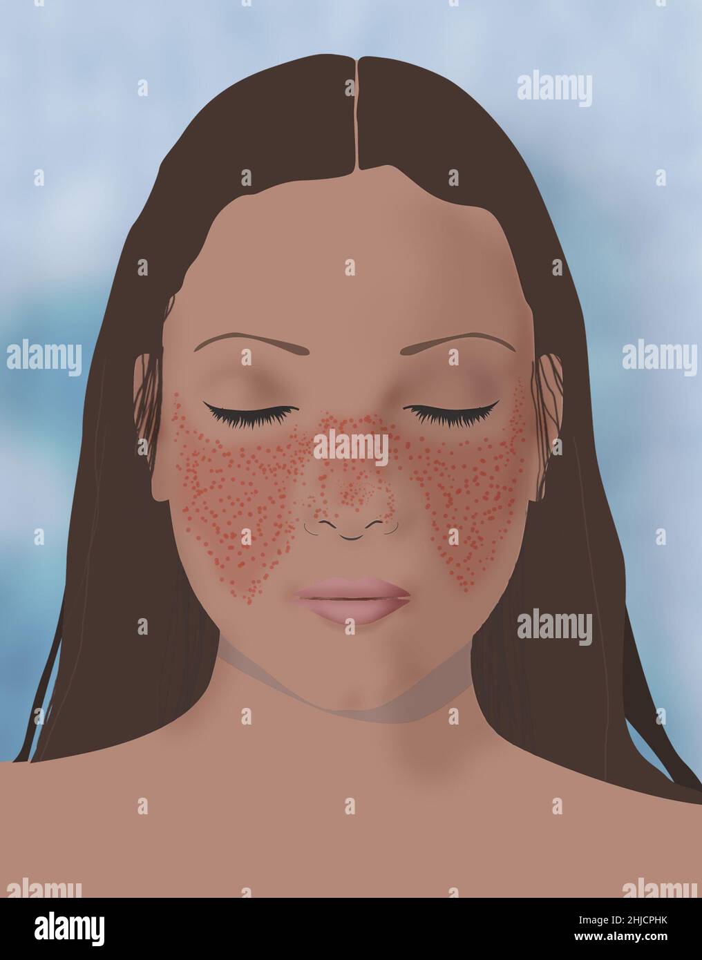 Systemic lupus erythematosus is a chronic inflammatory condition ...