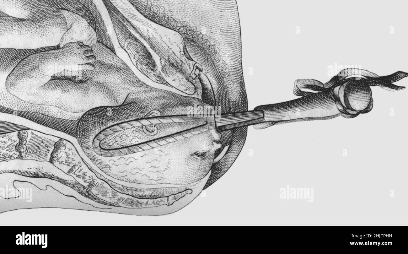 Smellie forceps. William Smellie (1697-1763) was a Scottish obstetrician and medical instructor who practiced and taught primarily in London. One of the first prominent male midwives in Britain, he designed an improved version of the obstetrical forceps, established safer delivery practices, and through his teaching and writing helped make obstetrics more scientifically based. Stock Photo