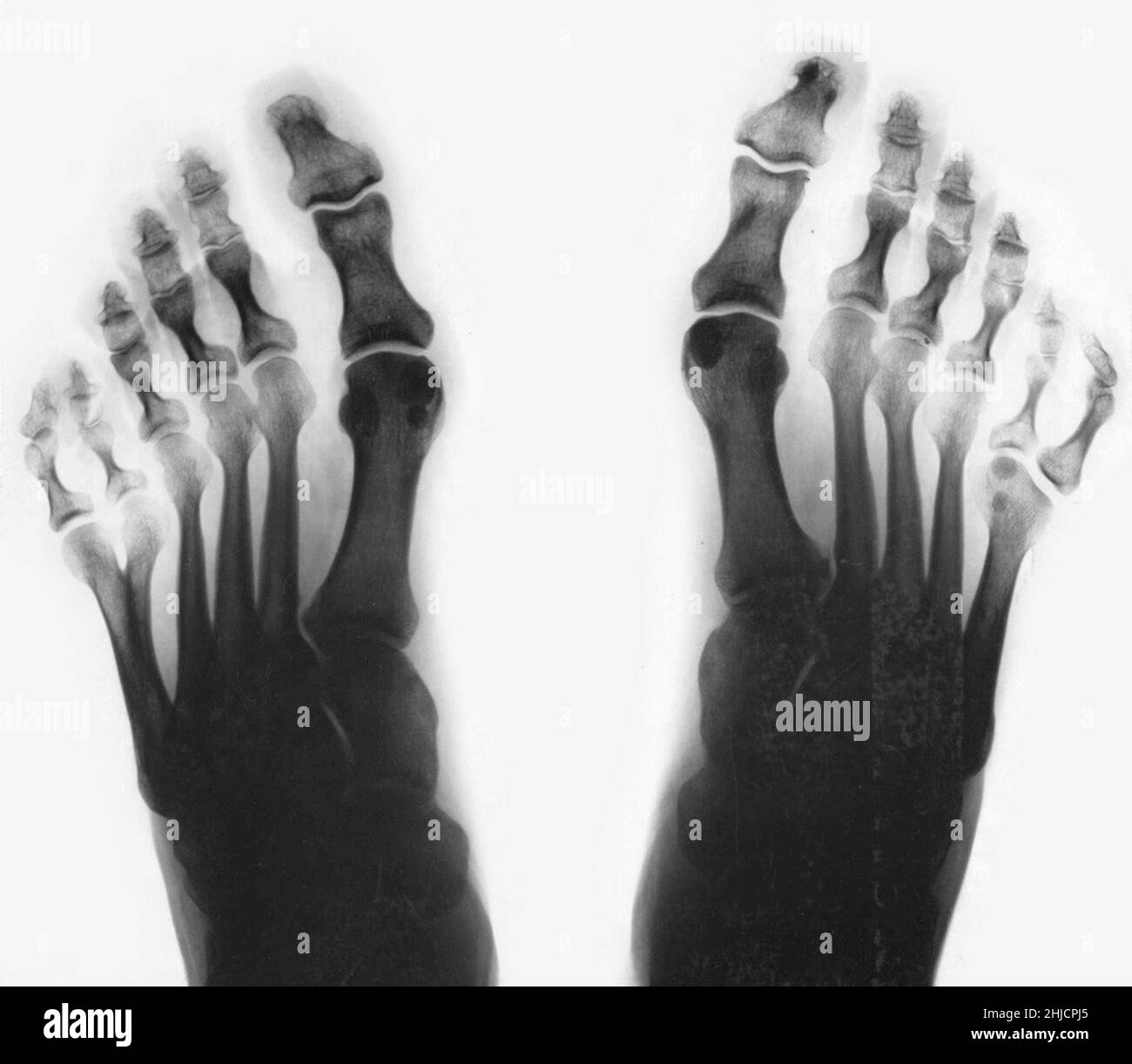 X-ray of feet, showing postaxial polydactyly. Polydactylism is the congenital abnormality of having extraneous fingers or toes. As visible above, this individual had six toes on both feet. This is an example of postaxial polydactyly, because the extra digit occurs on the pinky side of the foot. Stock Photo