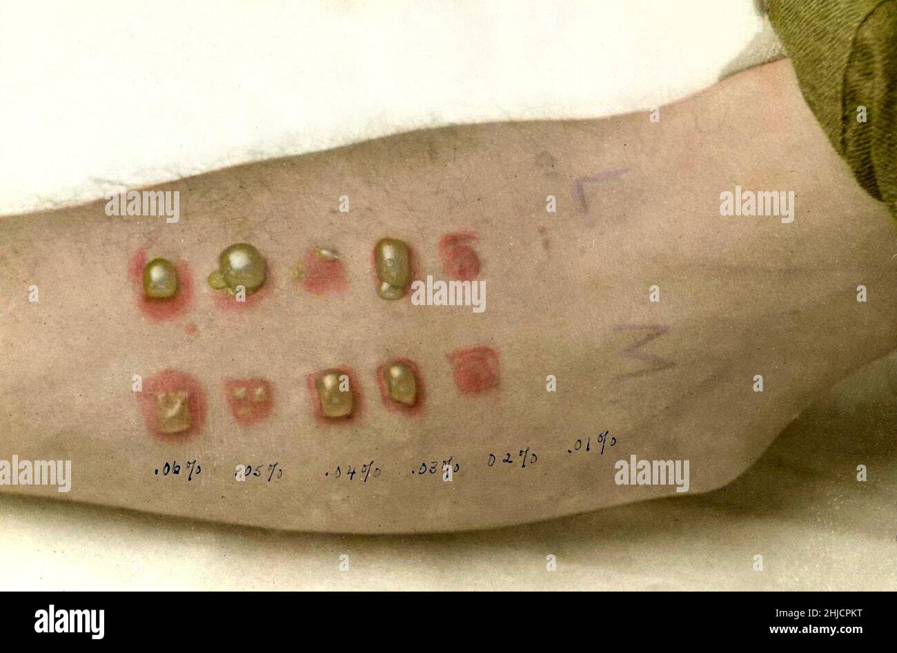 Hand-tinted photograph of a man with blisters from the application of old Mustard-1 and fresh Mustard-1 (a type of mustard gas) at end of one day. The concentrations, ranging from 0.01% to 0.06%, are handwritten underneath. Photograph by W.W. Hicks. Chemical gases were broadly used during World War I to cause incapacitation, harm, or death to opposing troops. The types of chemicals ranged from agents such as tear gas to lethal gases, such as phosgene, mustard gas, and chlorine. Their effectiveness diminished in the later stages of the war due to countermeasures, such as gas masks. The use of p Stock Photo