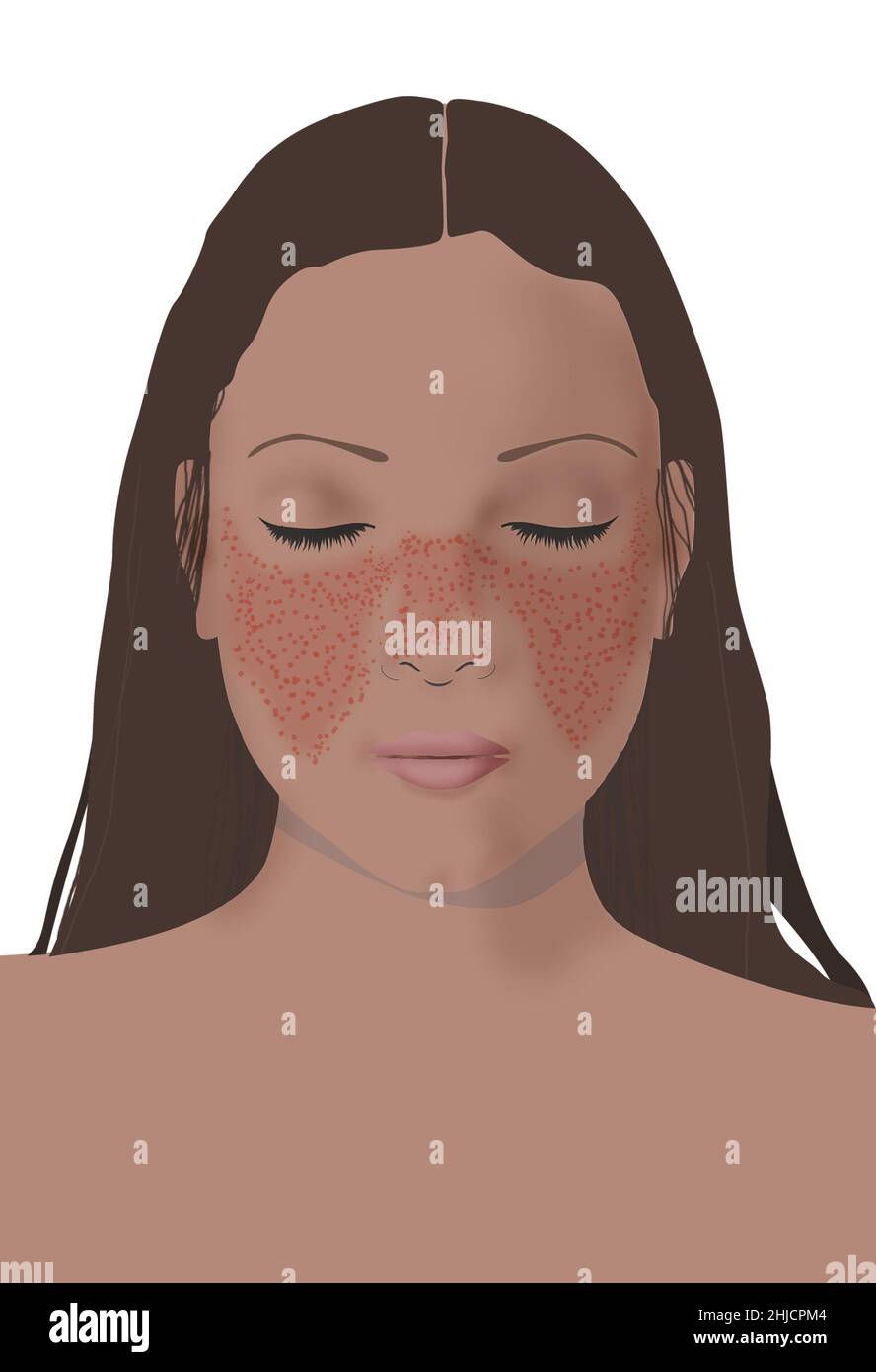 Systemic lupus erythematosus is a chronic inflammatory condition. Symptoms may only be the skin rash, but other symptoms may occur such as joint pain.  It is an autoimmune disease when the body's tissues are attacked by its own immune system. Patients with lupus have antibodies in their blood that are targeted against their own body tissues. Stock Photo