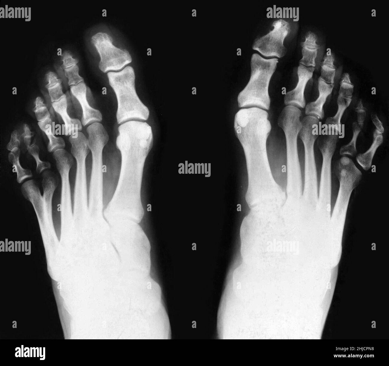 X-ray of feet, showing postaxial polydactyly. Polydactylism is the congenital abnormality of having extraneous fingers or toes. As visible above, this individual had six toes on both feet. This is an example of postaxial polydactyly, because the extra digit occurs on the pinky side of the foot. Stock Photo