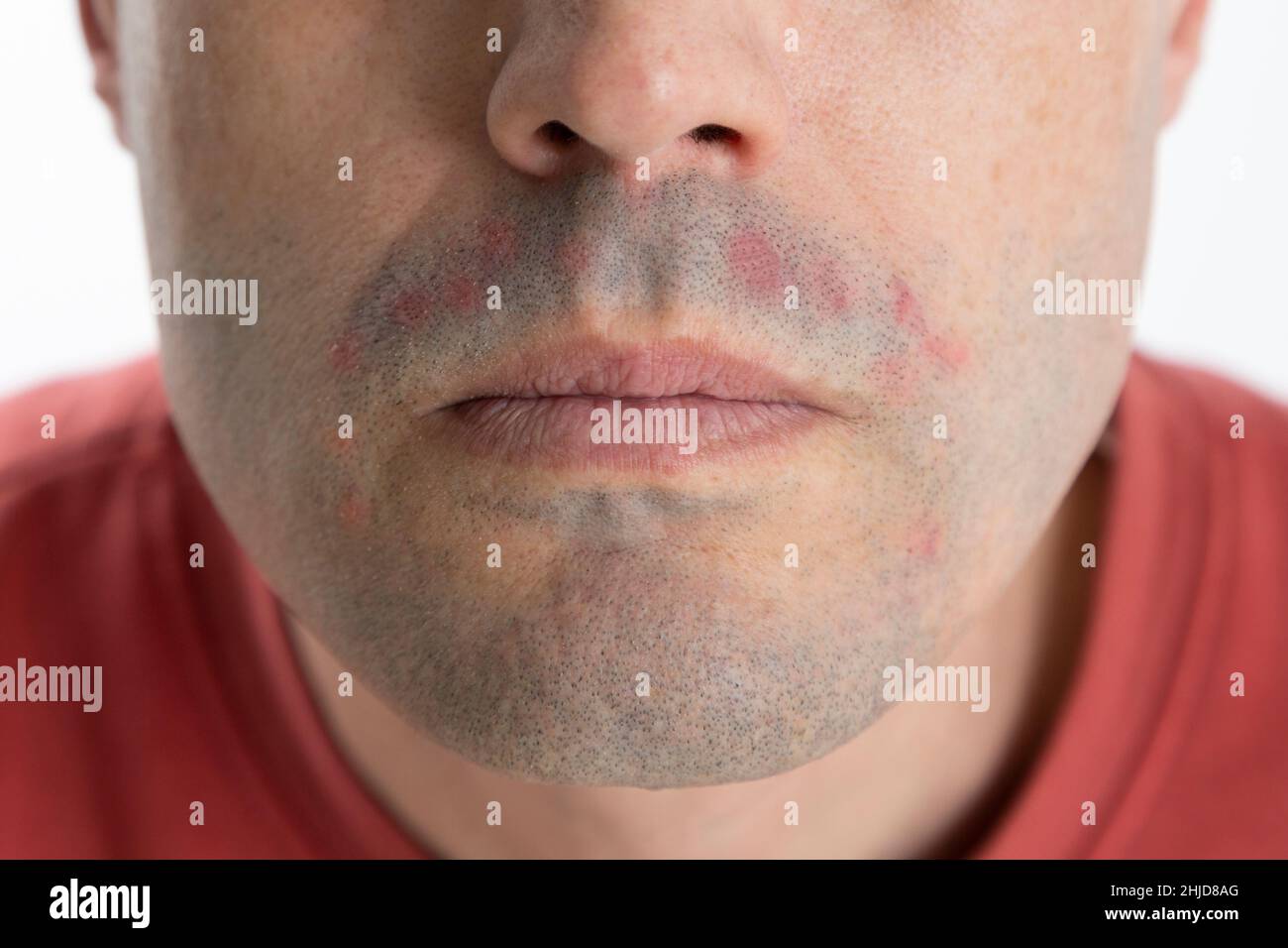 Chin Of A Man With Dermatitis After Shaving Male Skin Problems And