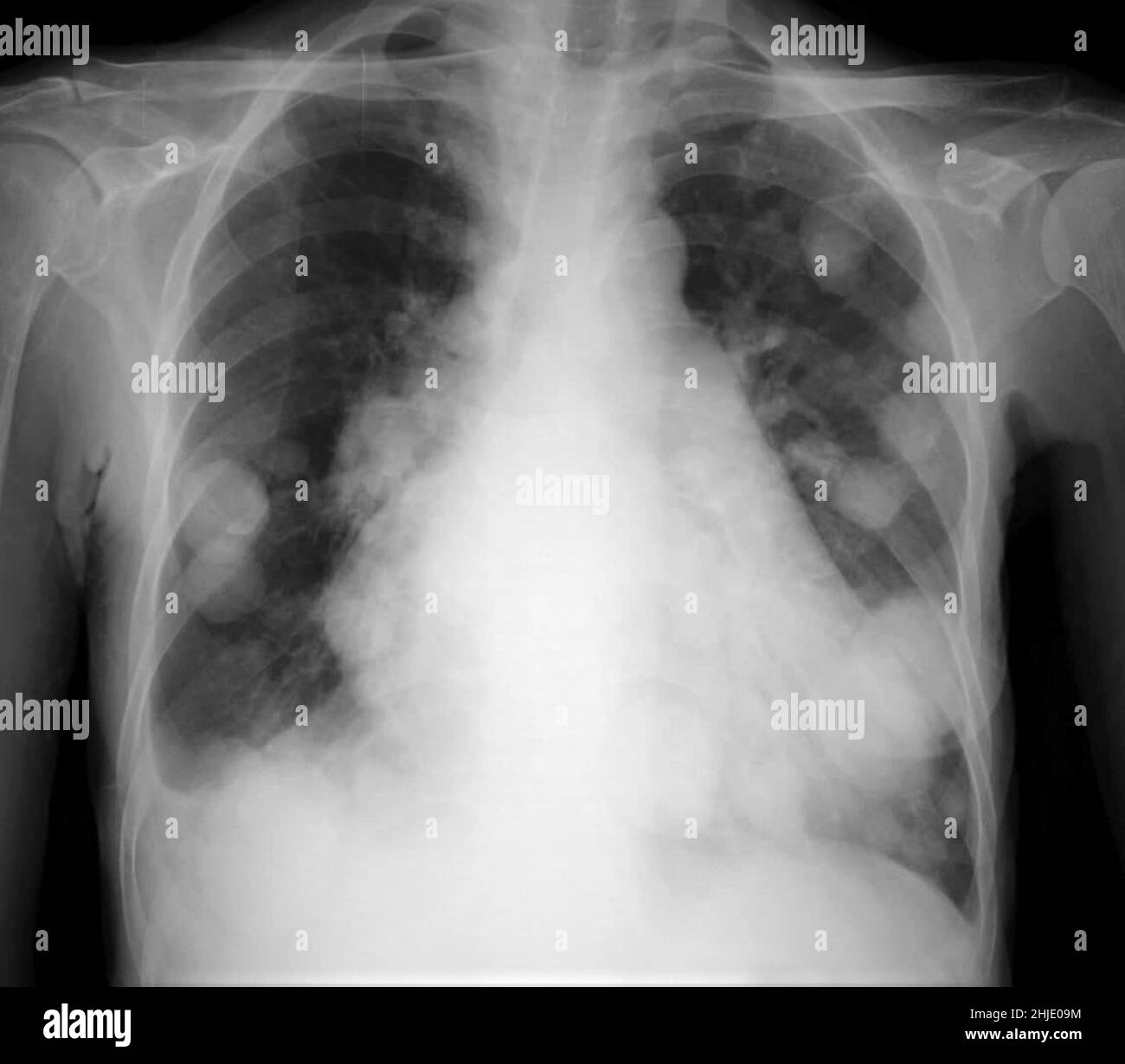 Cannonball pulmonary metastases, Xray Stock Photo Alamy