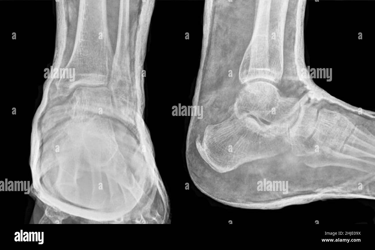 Fractured ankle in cast, X-ray Stock Photo