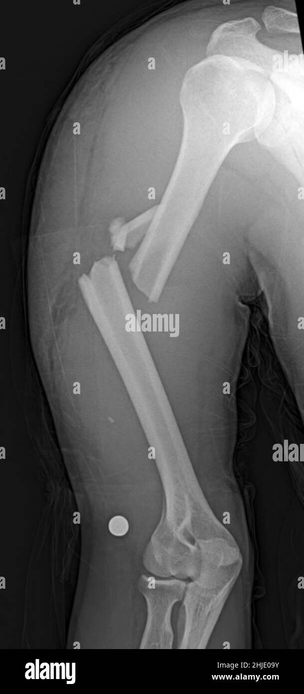 Fractured arm, X-ray Stock Photo