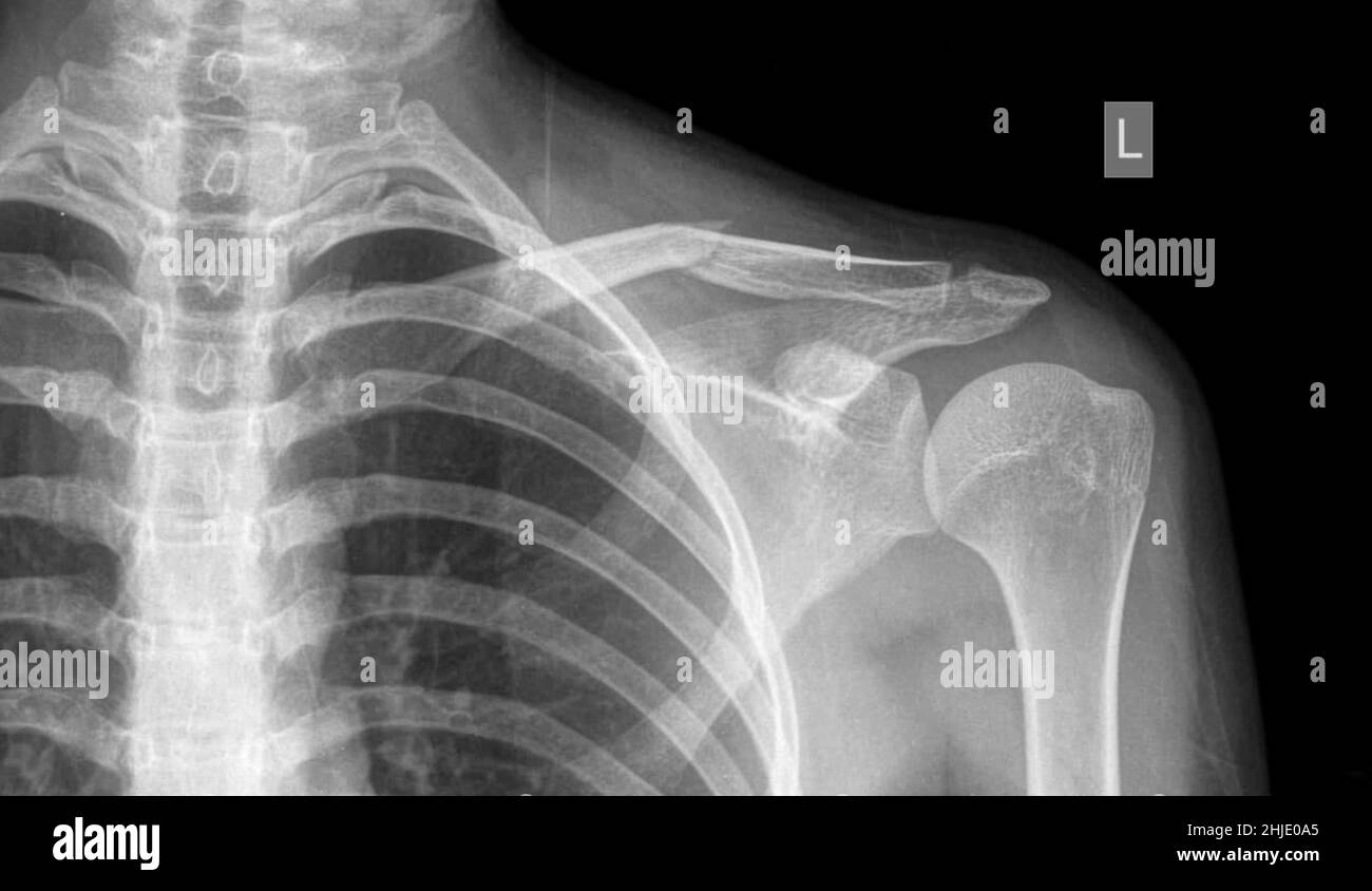 Fractured collar bone, X-ray Stock Photo