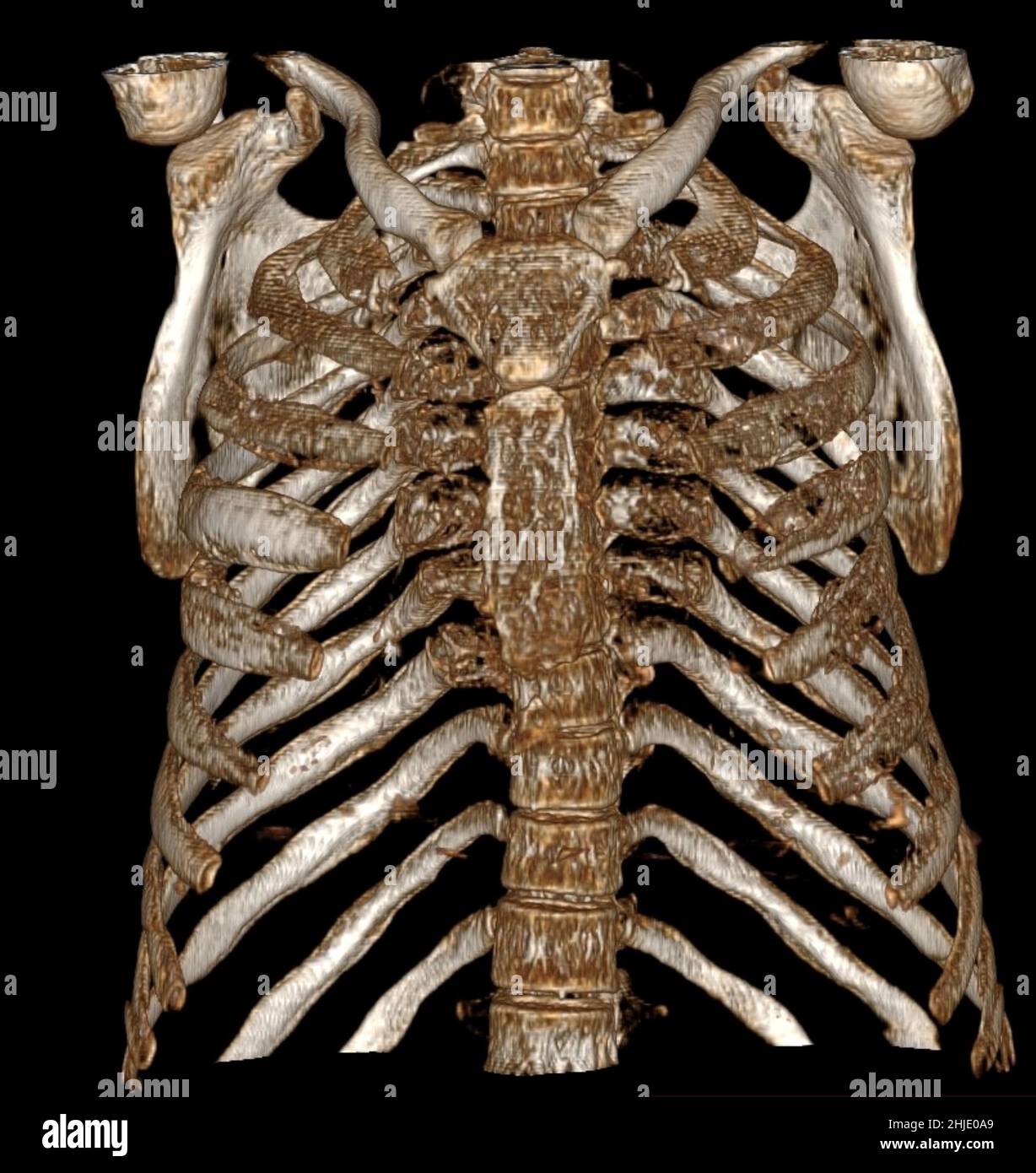 Extramedullary haematopoiesis, 3D CT scan Stock Photo