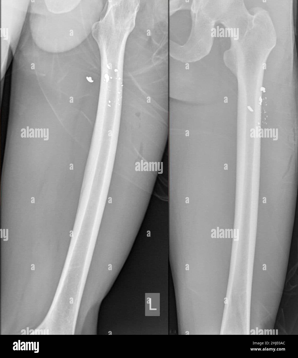 Gun shot in thigh, X-ray Stock Photo