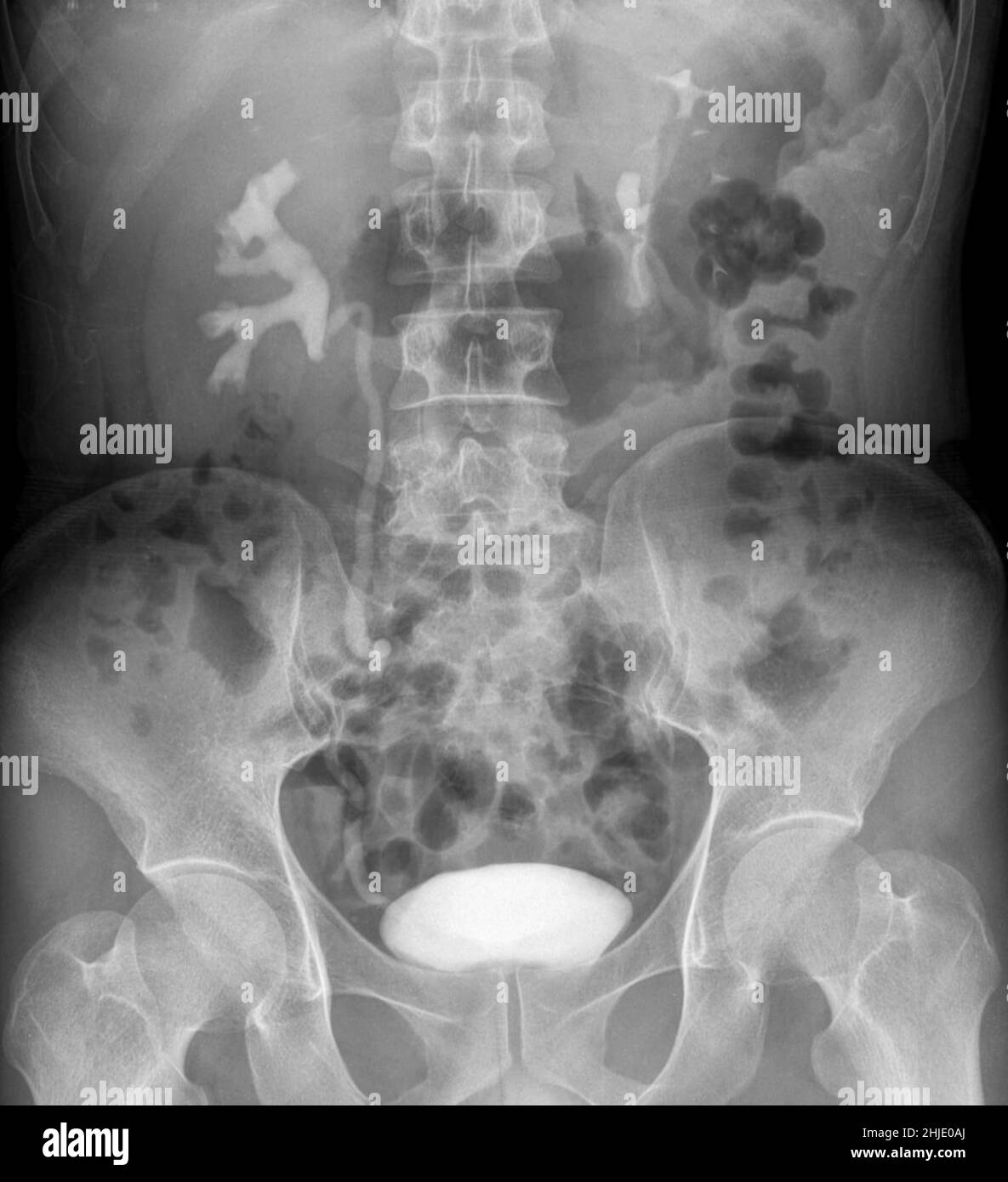 swollen-kidney-x-ray-stock-photo-alamy