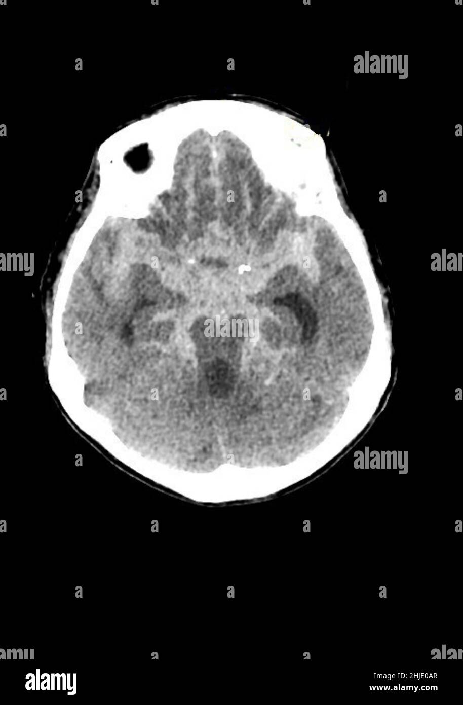 Subarachnoid haemorrhage, CT scan Stock Photo Alamy