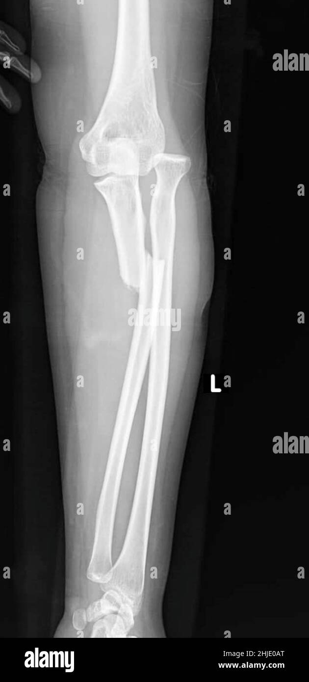 Monteggia fracture, Xray Stock Photo Alamy