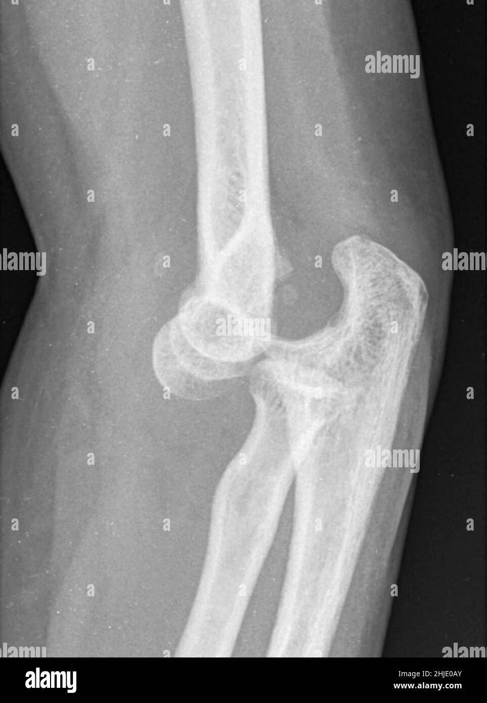 Dislocated elbow, X-ray Stock Photo