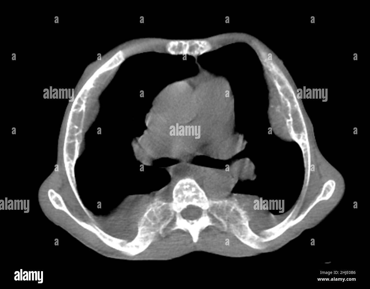 Extramedullary haematopoiesis, CT scan Stock Photo