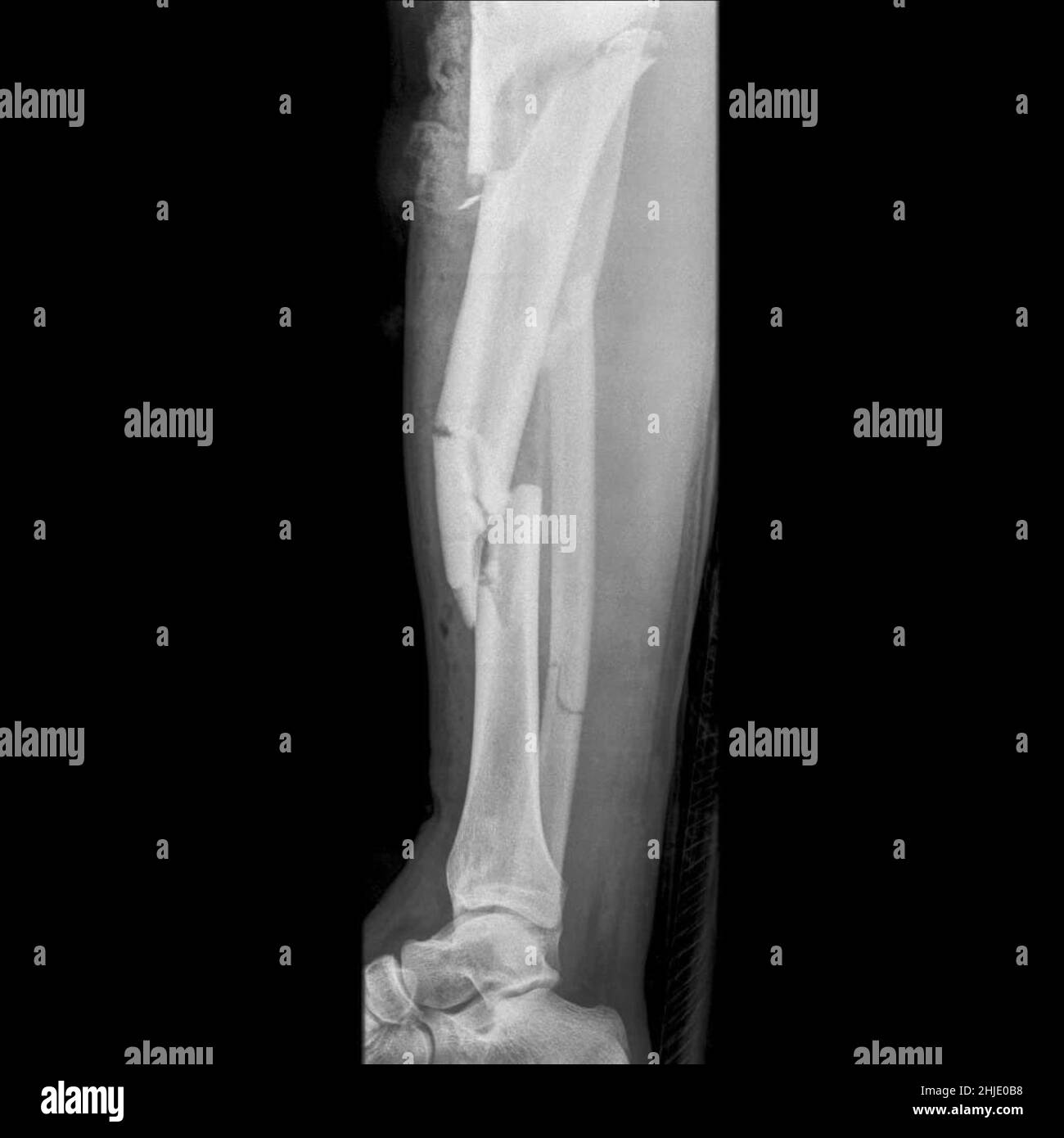 Compound Fracture X Ray