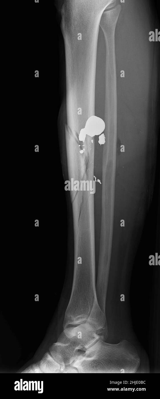 X ray of gun hi-res stock photography and images - Alamy