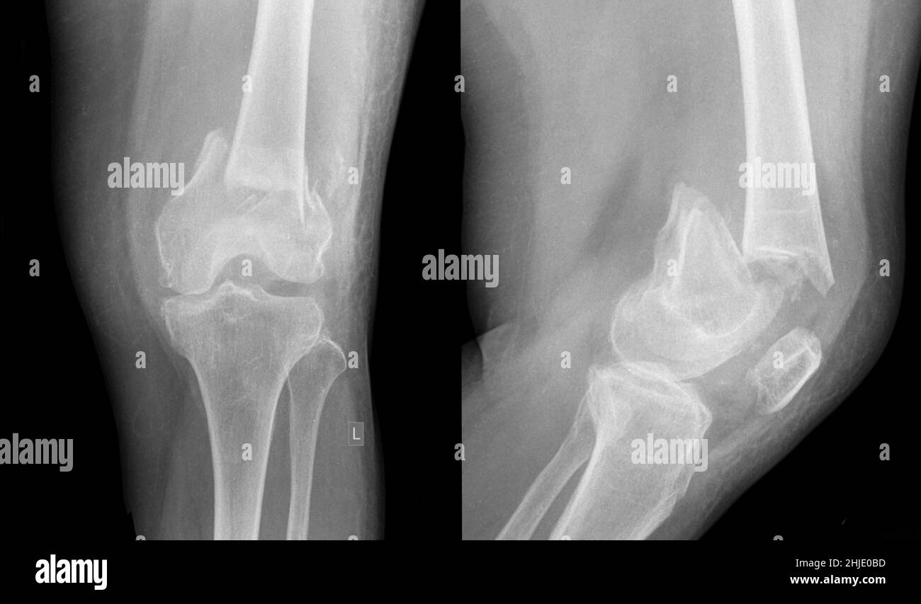 Fractured leg, Xray Stock Photo Alamy