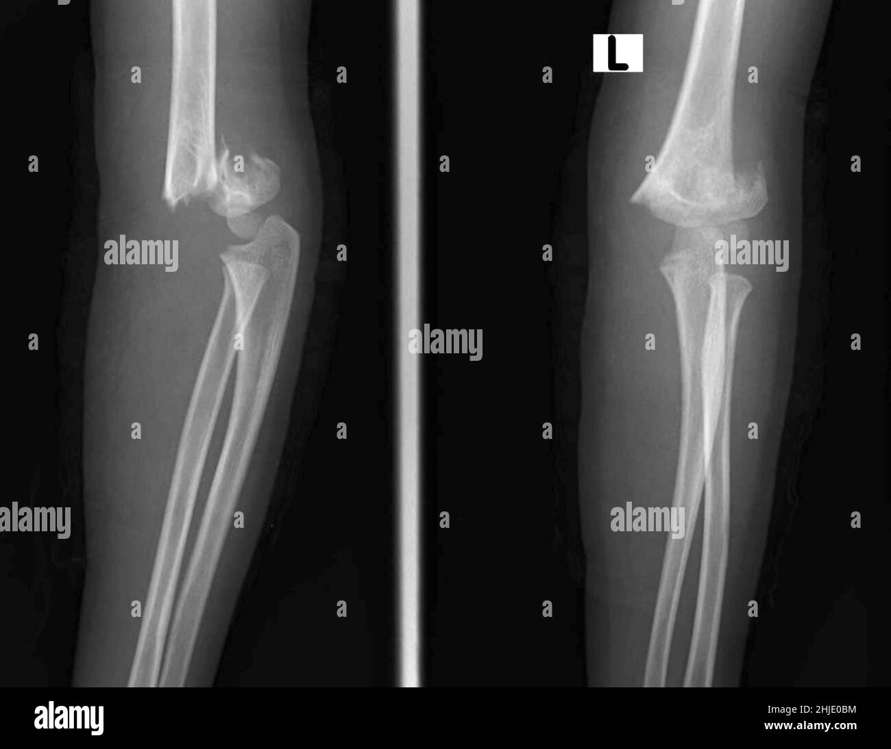 Supracondylar Humerus Fracture X ray Stock Photo Alamy