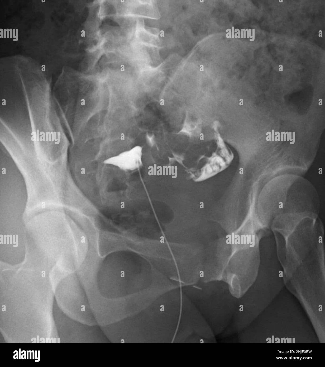 Fallopian tube Black and White Stock Photos & Images Alamy