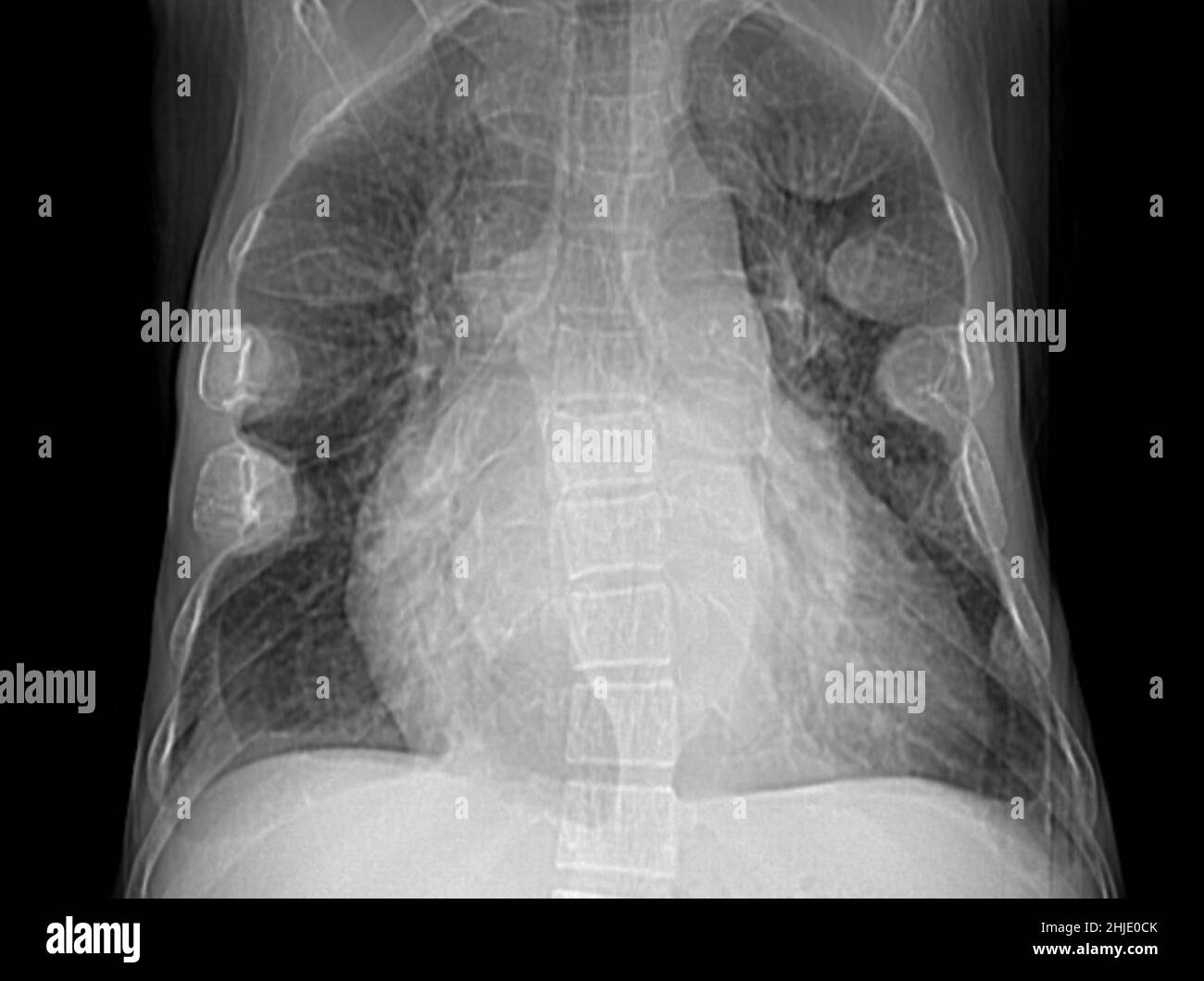 Extramedullary haematopoiesis, X-ray Stock Photo