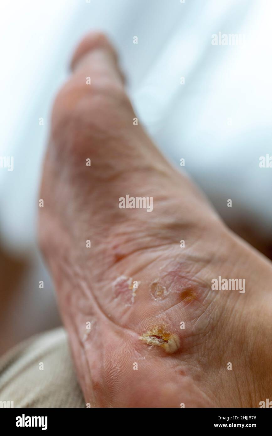 Close up of foot with scabs and blisters caused by pompholyx aka dyshidrotic eczema Stock Photo
