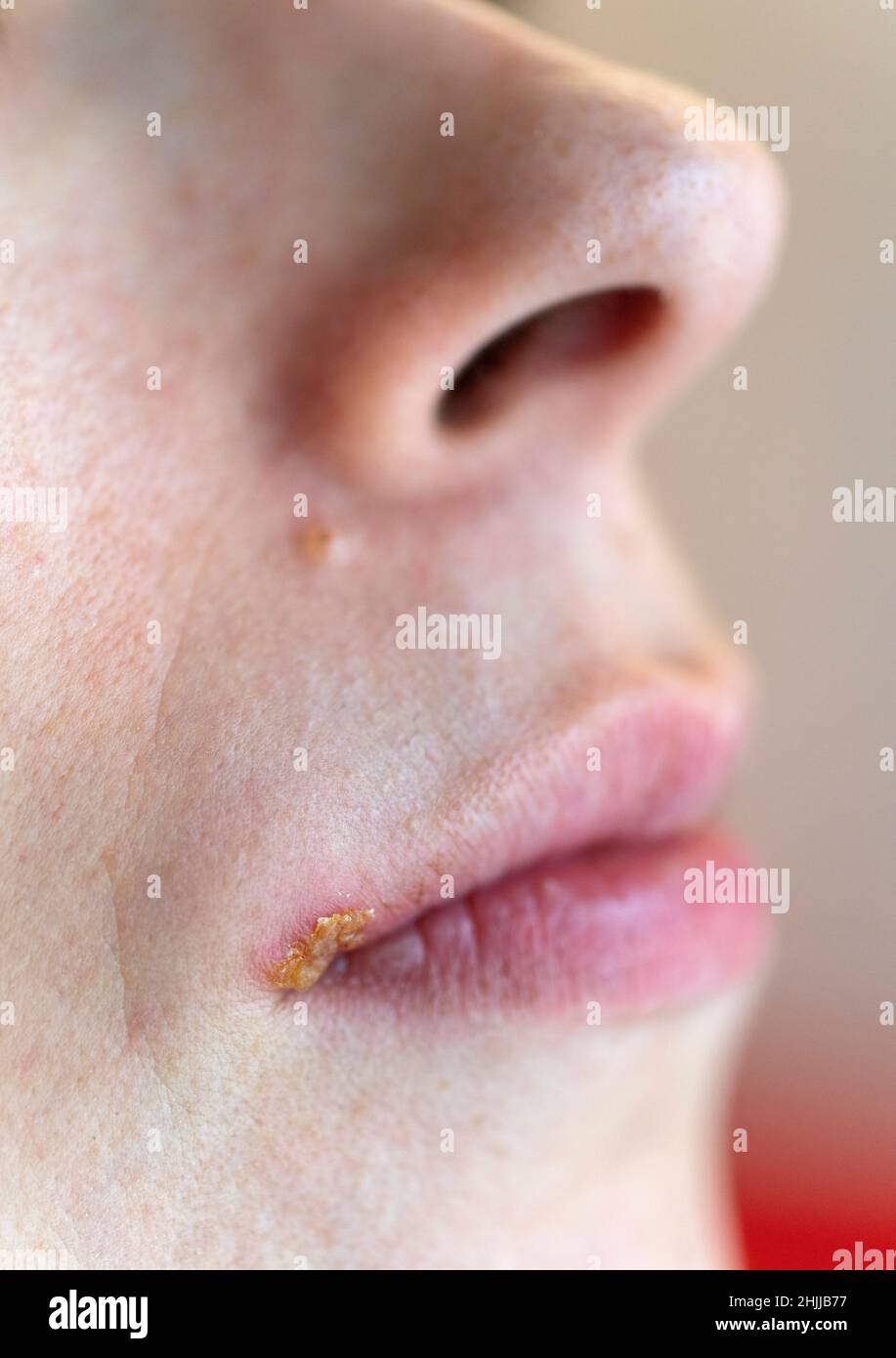 Herpesvirus Hi-res Stock Photography And Images - Alamy