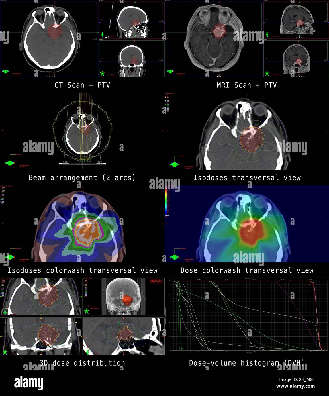 Illustration of a modern radiation plan for cancer therapy of a patient with a brain tumor (meningioma). Stock Photo