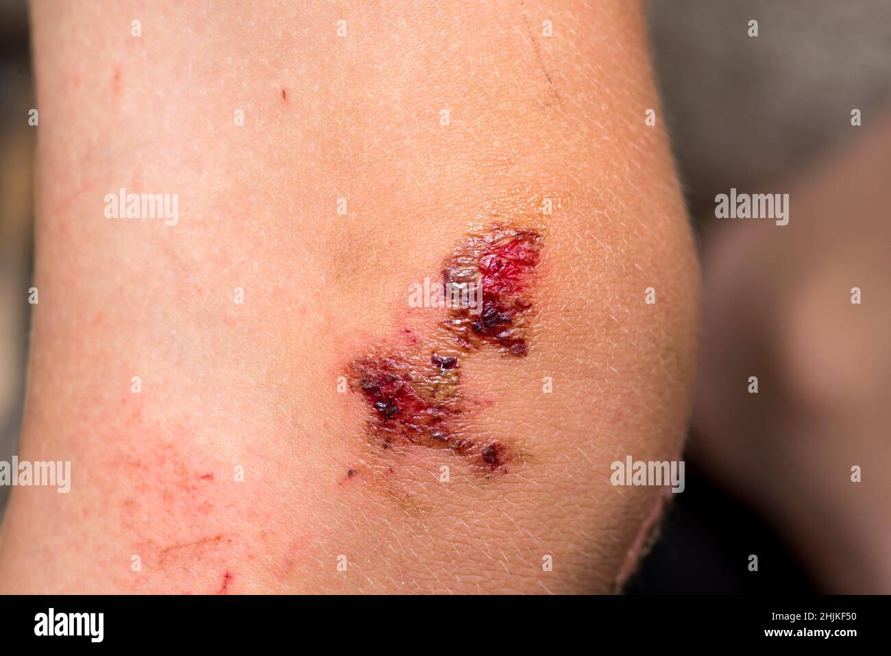 Skin scrape knee child hires stock photography and images Alamy