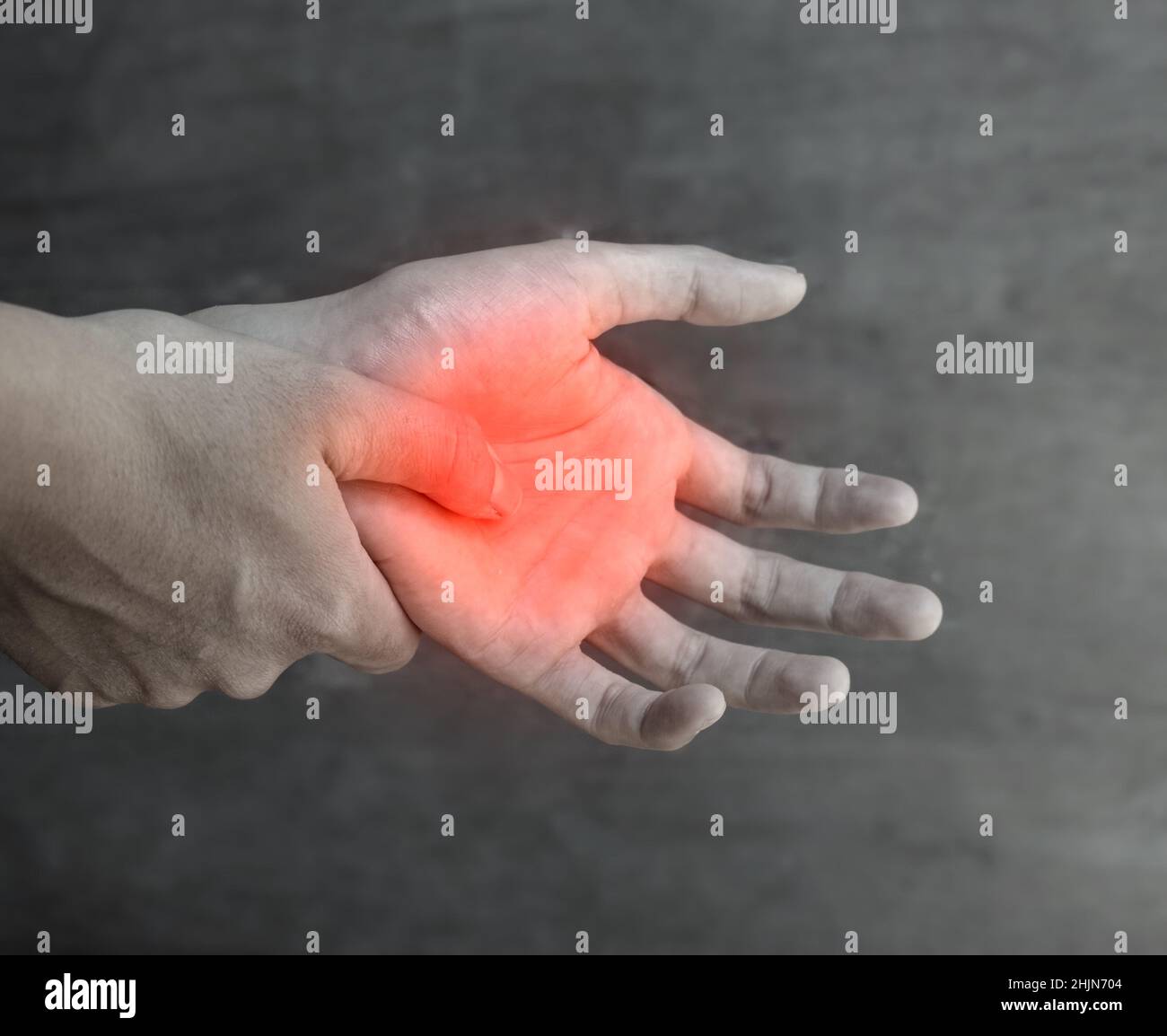 Painful palmar aspect of Asian young man. Concept of compartment