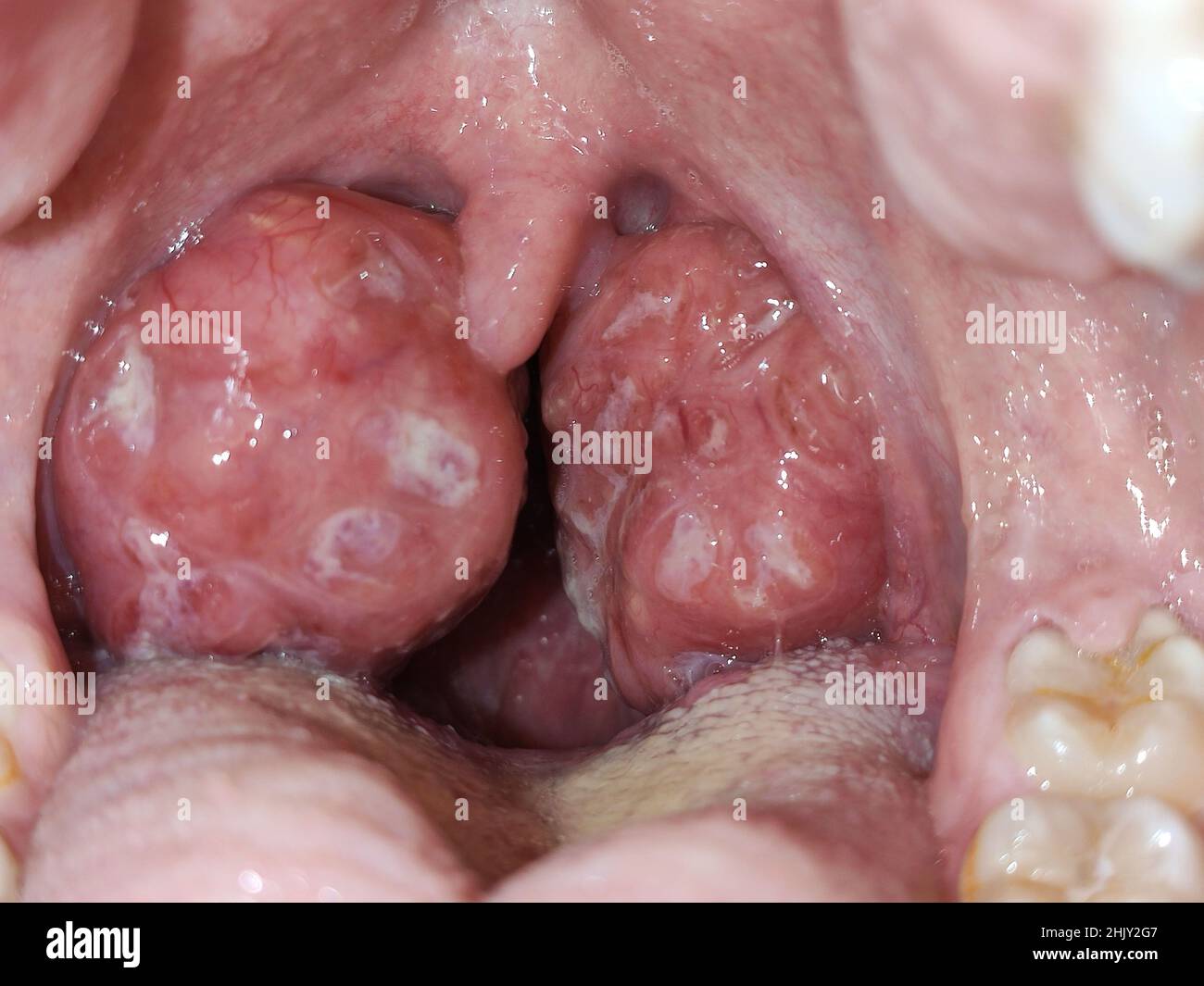 Tonsils. Swollen tonsils with plaque due to acute anguineous. Horizontal photography. Stock Photo