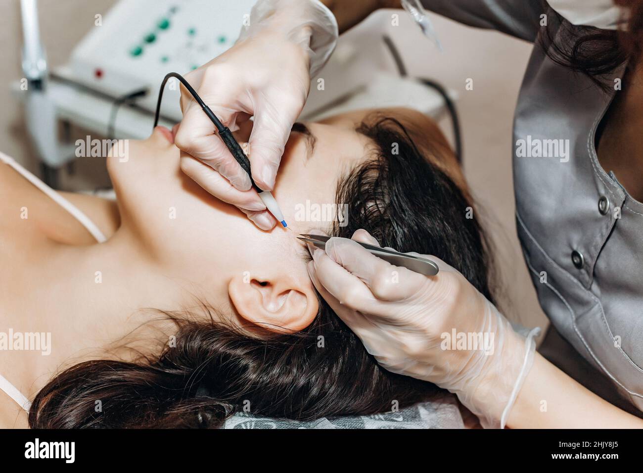 The process of permanent removal of unwanted facial hair using an electroepilation device and tweezers. Stock Photo