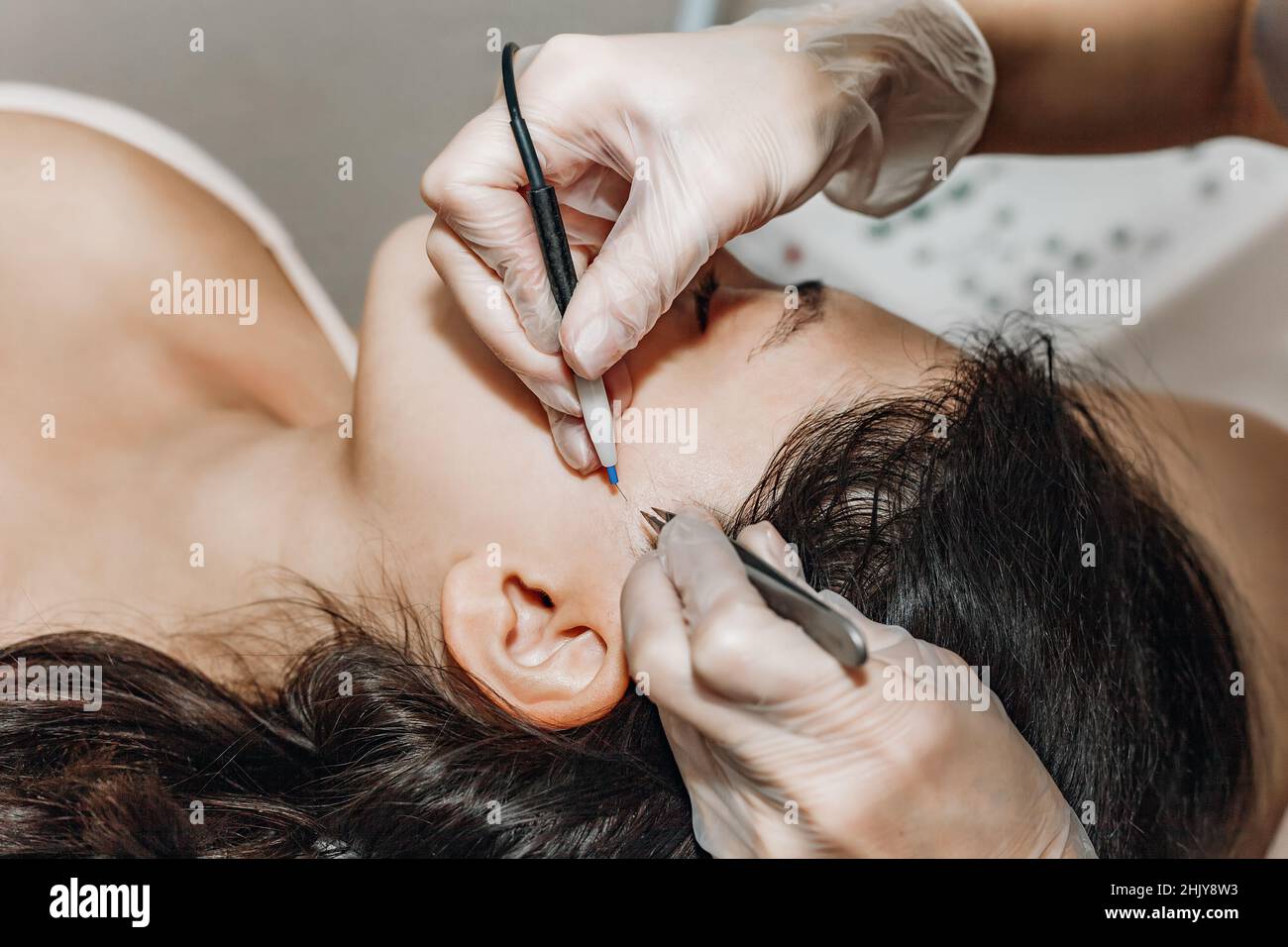 Female cosmetologist performs the procedure of permanent removal of unwanted facial hair by electroepilation. Stock Photo