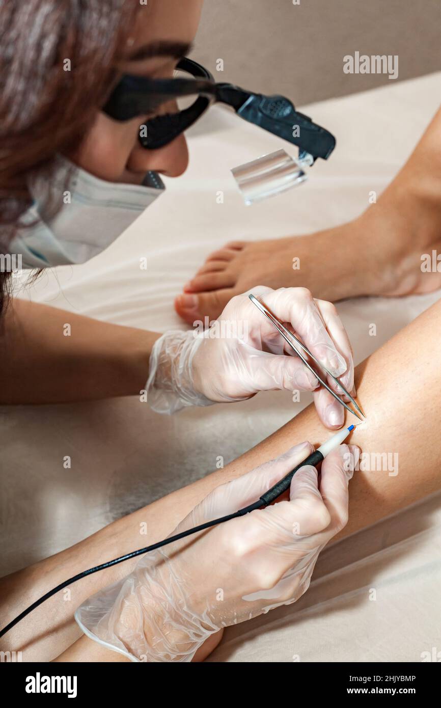 A female cosmetologist performs the procedure of permanent removal of unwanted hair on the client's legs by electroepilation. Stock Photo