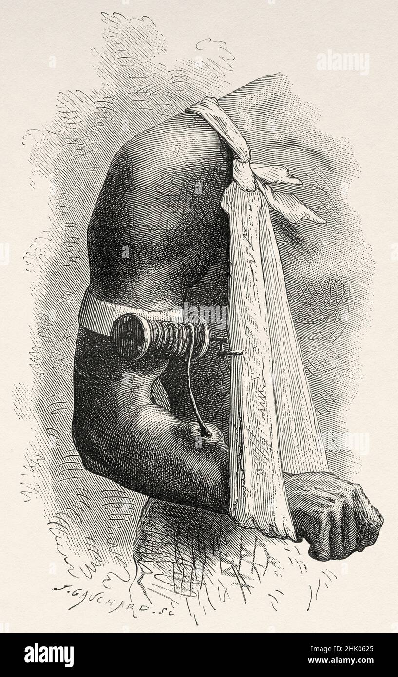 Guinea worm disease. Dracunculiasis. A disease caused by nematode roundworm Dracunculus medinensis, it occurs by drinking unfiltered water containing copepods infected with larvae. Old 19th century engraved illustration from Four months in Florida by Achille Poussielgue, Le Tour du Monde 1870 Stock Photo