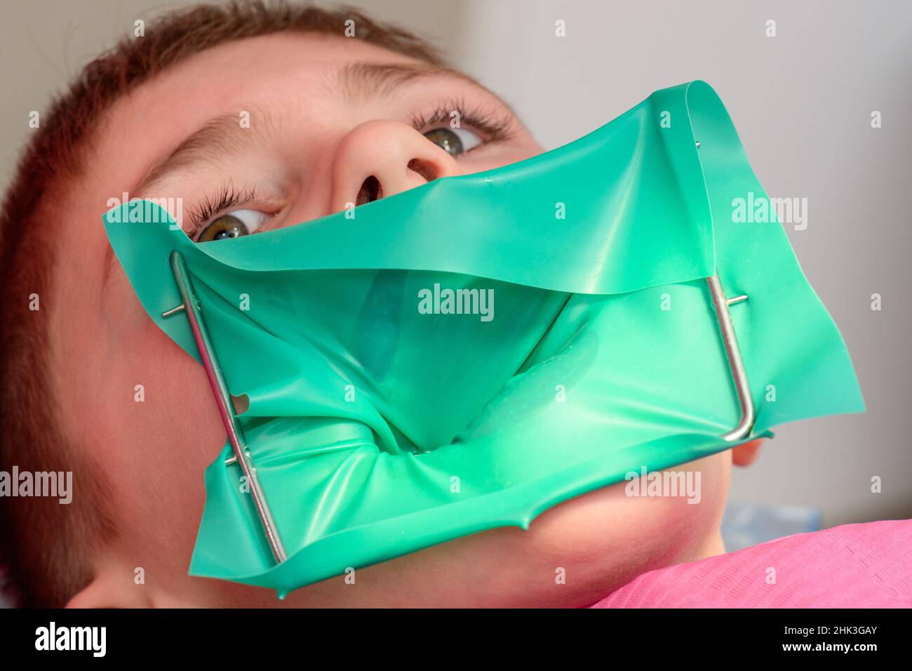 The dentist treats the child's tooth using a rubber dam, installing a