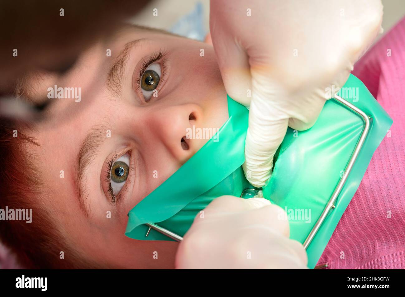 The dentist treats the child's tooth using a rubber dam, installing a