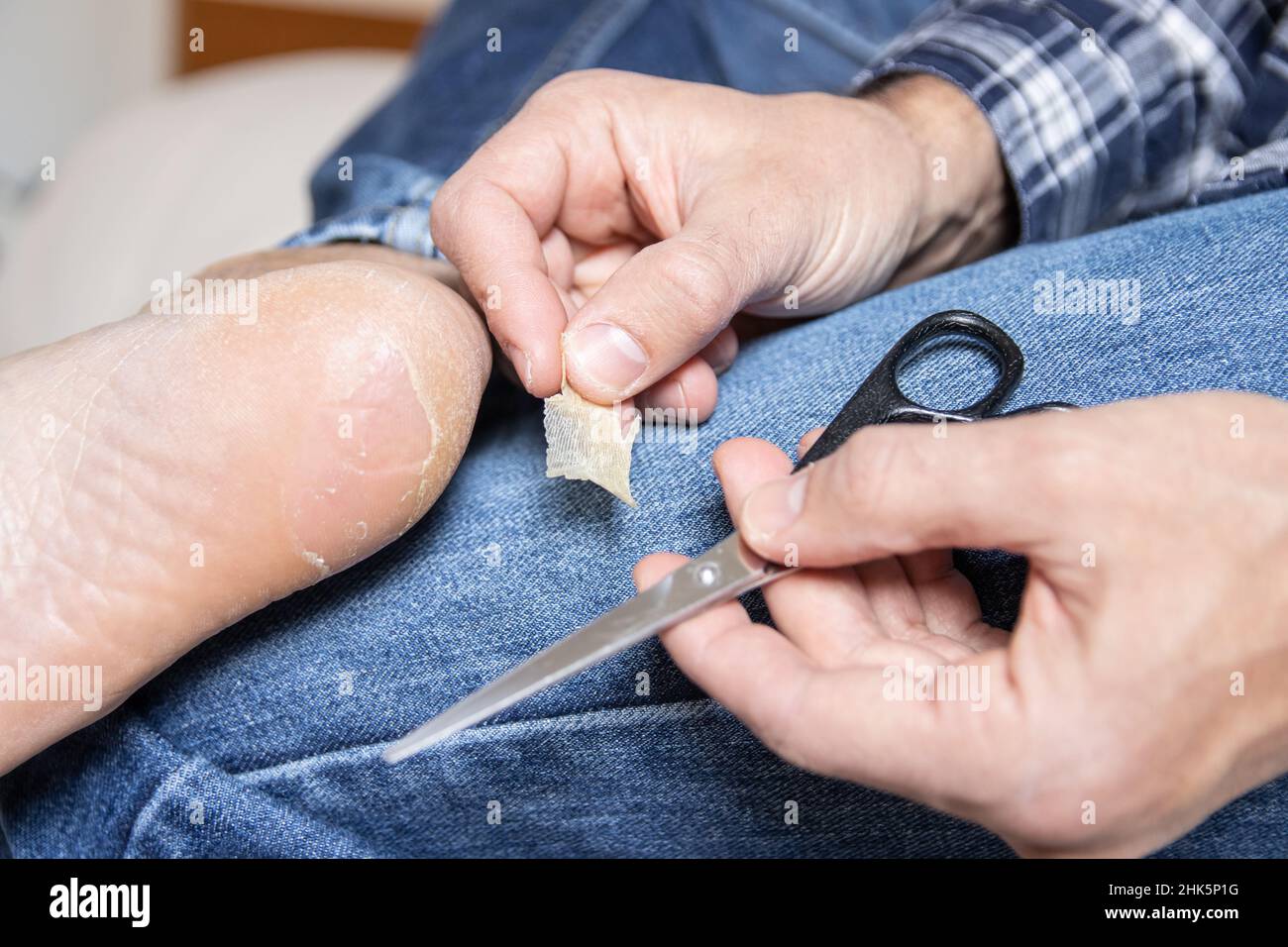 Broken and dry blister skin on the foot Stock Photo