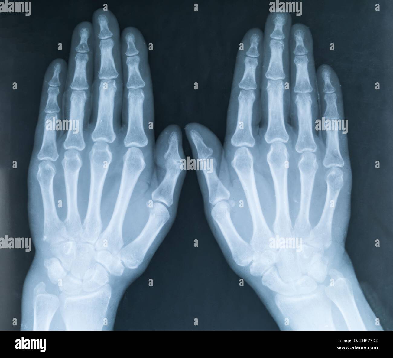 X-ray of two human hands. X-ray image of the hands of a senior woman with Osteoarthritis Stock Photo