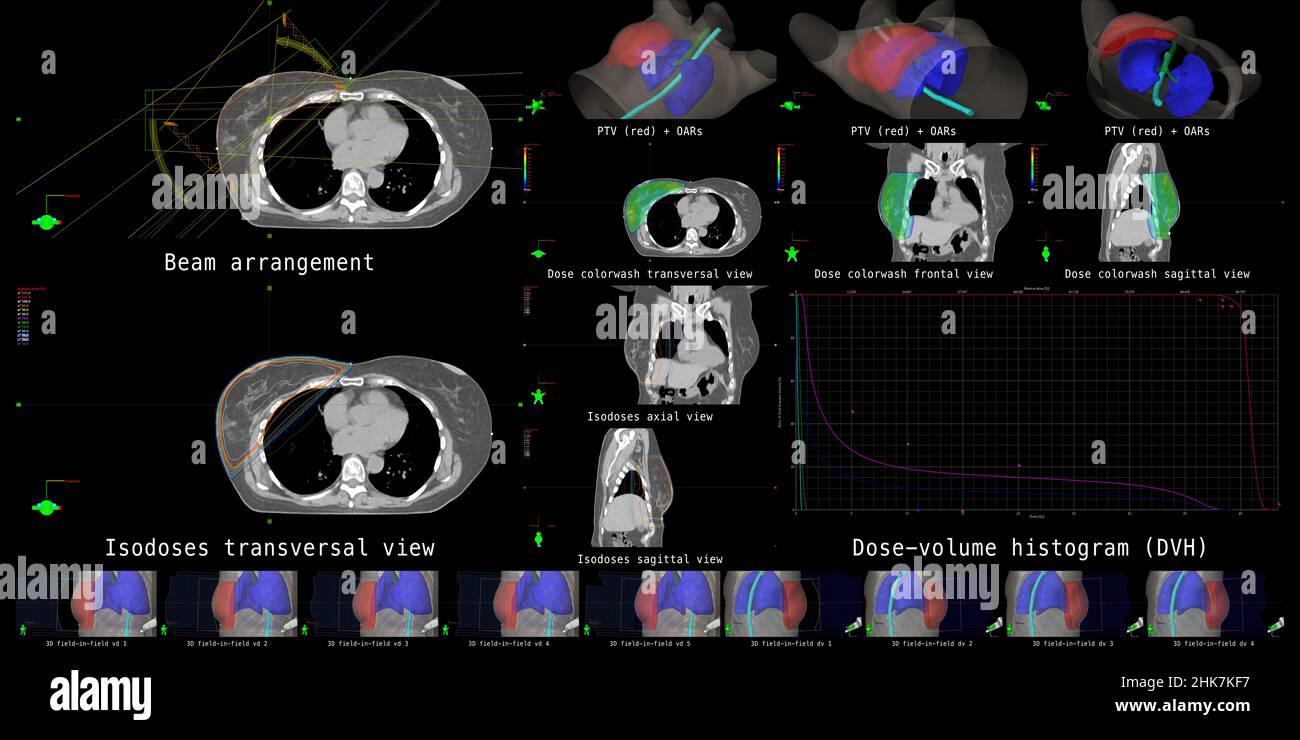 The overview shows beam configurations, dose calculations and dose