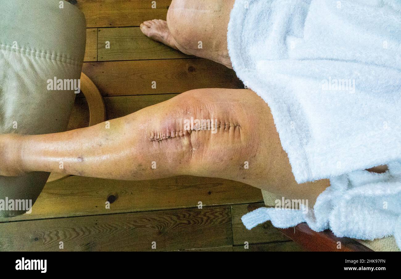 Knee replacement surgery scar with 23 clips, UK. 12 days post op Stock Photo