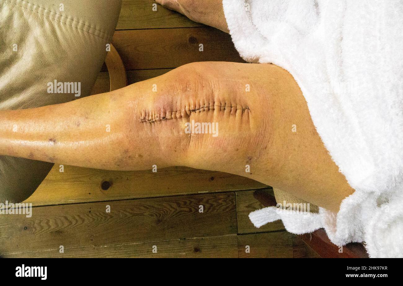 Knee replacement surgery scar with 23 clips,12 days post op. UK Stock Photo