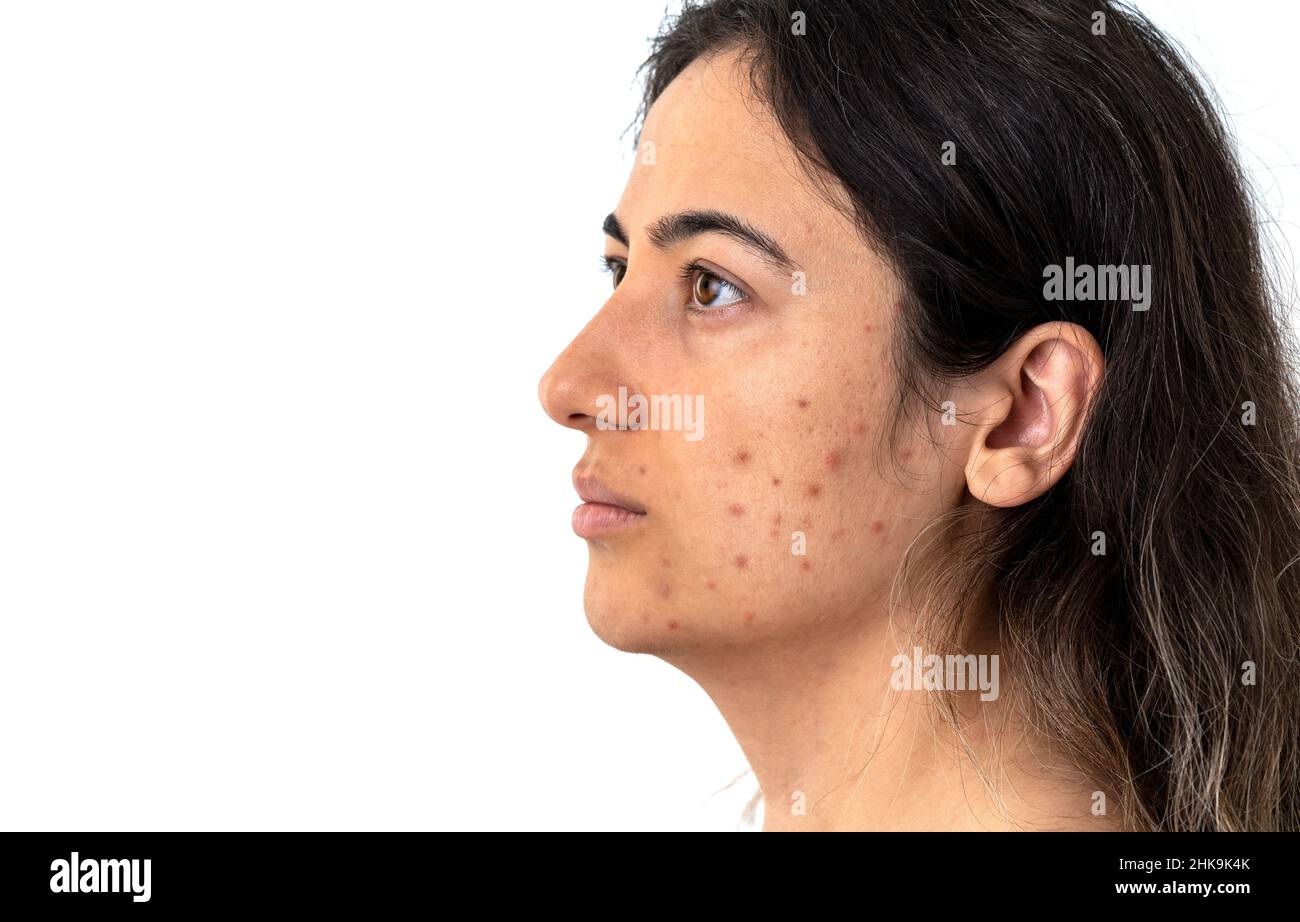 Close up photo of woman with excessive amount of pimples on the face. Concept of beauty and skin care. Stock Photo