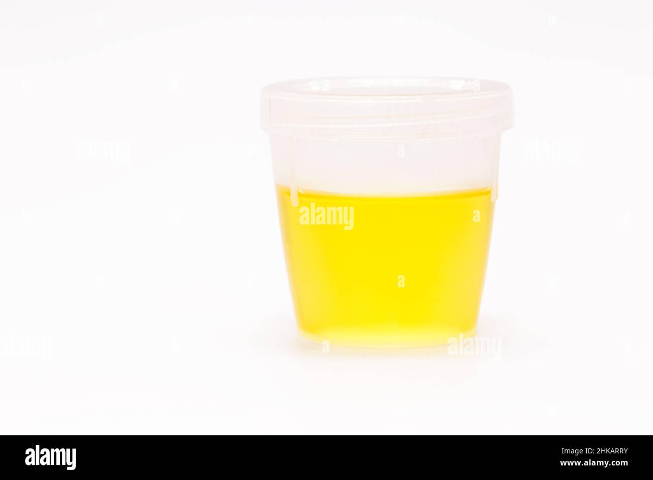 collection bottle with urine, urinalysis EAS Abnormal Sediment