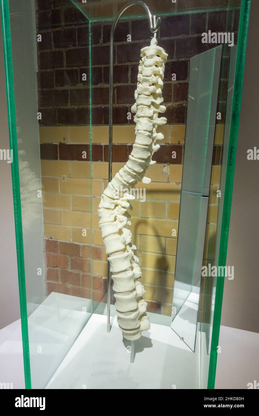 Model of King Richard III's spine showing effect of scoliosis, on