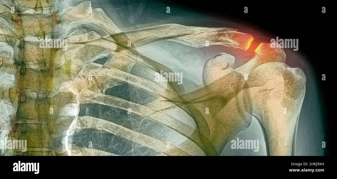 Fractured collar bone, Xray Stock Photo Alamy