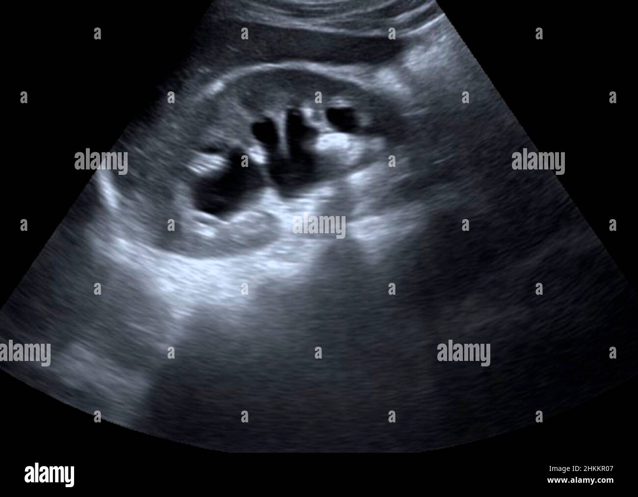 Kidney stones