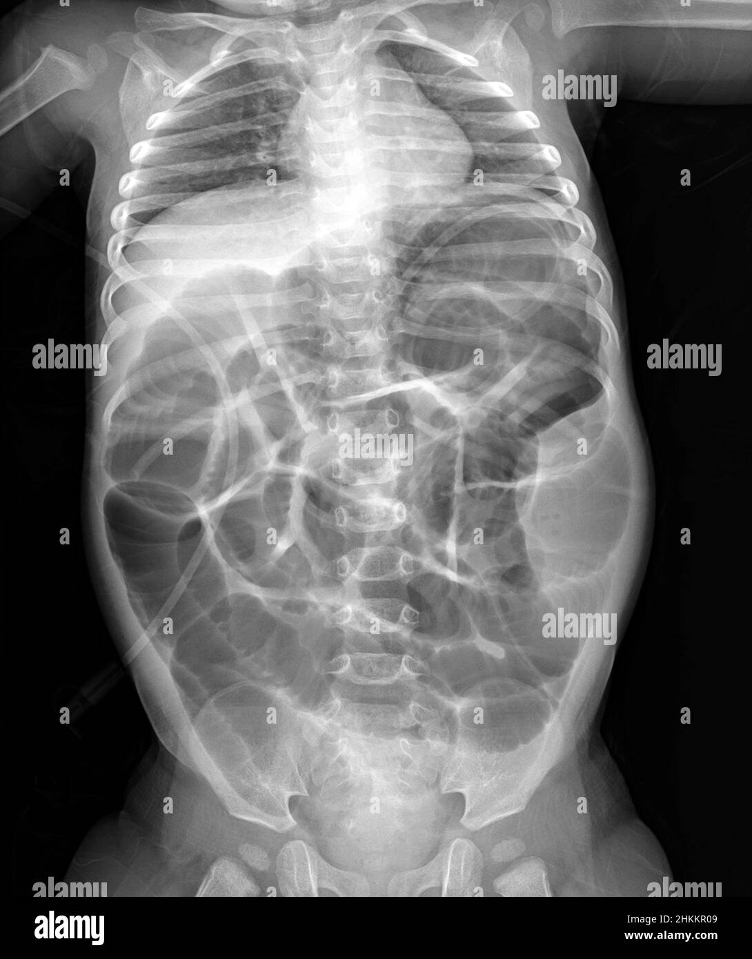 Intussusception of the intestines, X-ray Stock Photo