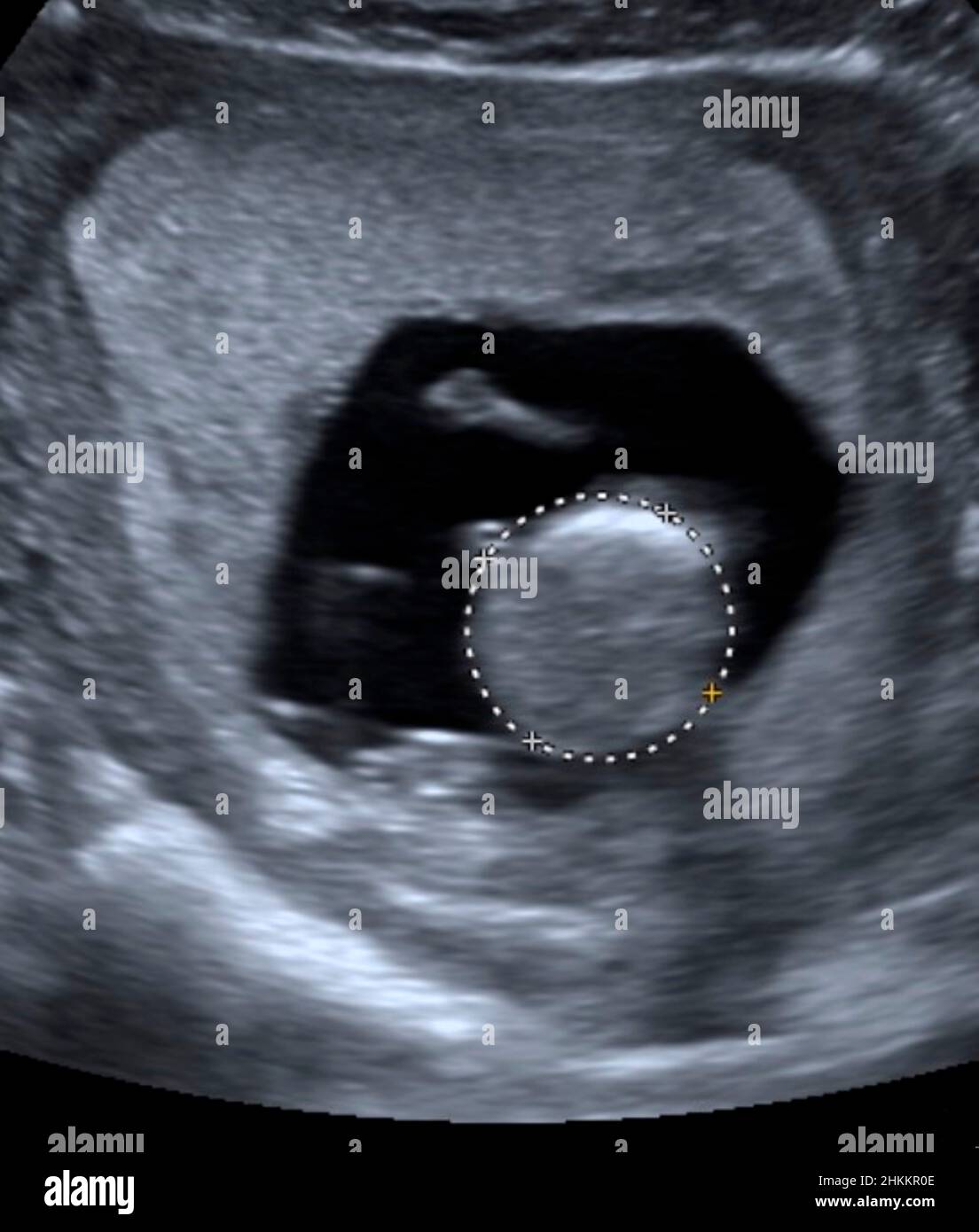 Fetal ultrasound hi res stock photography and images Alamy