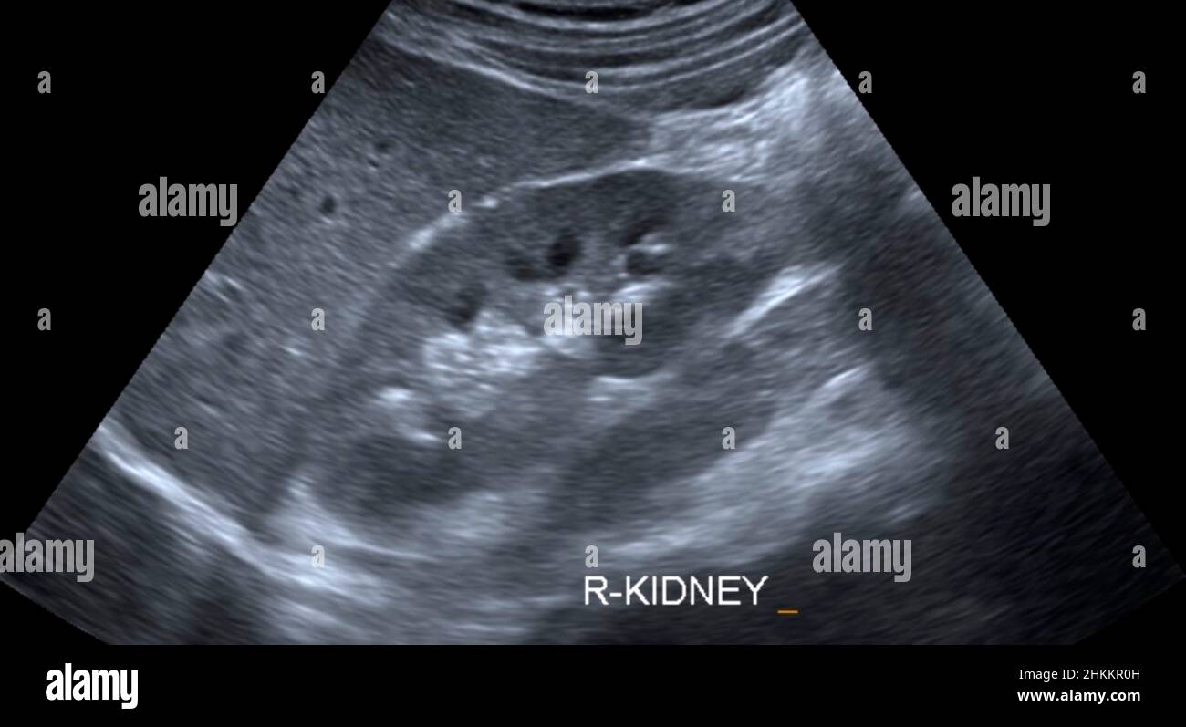 Healthy kidney, ultrasound scan Stock Photo - Alamy