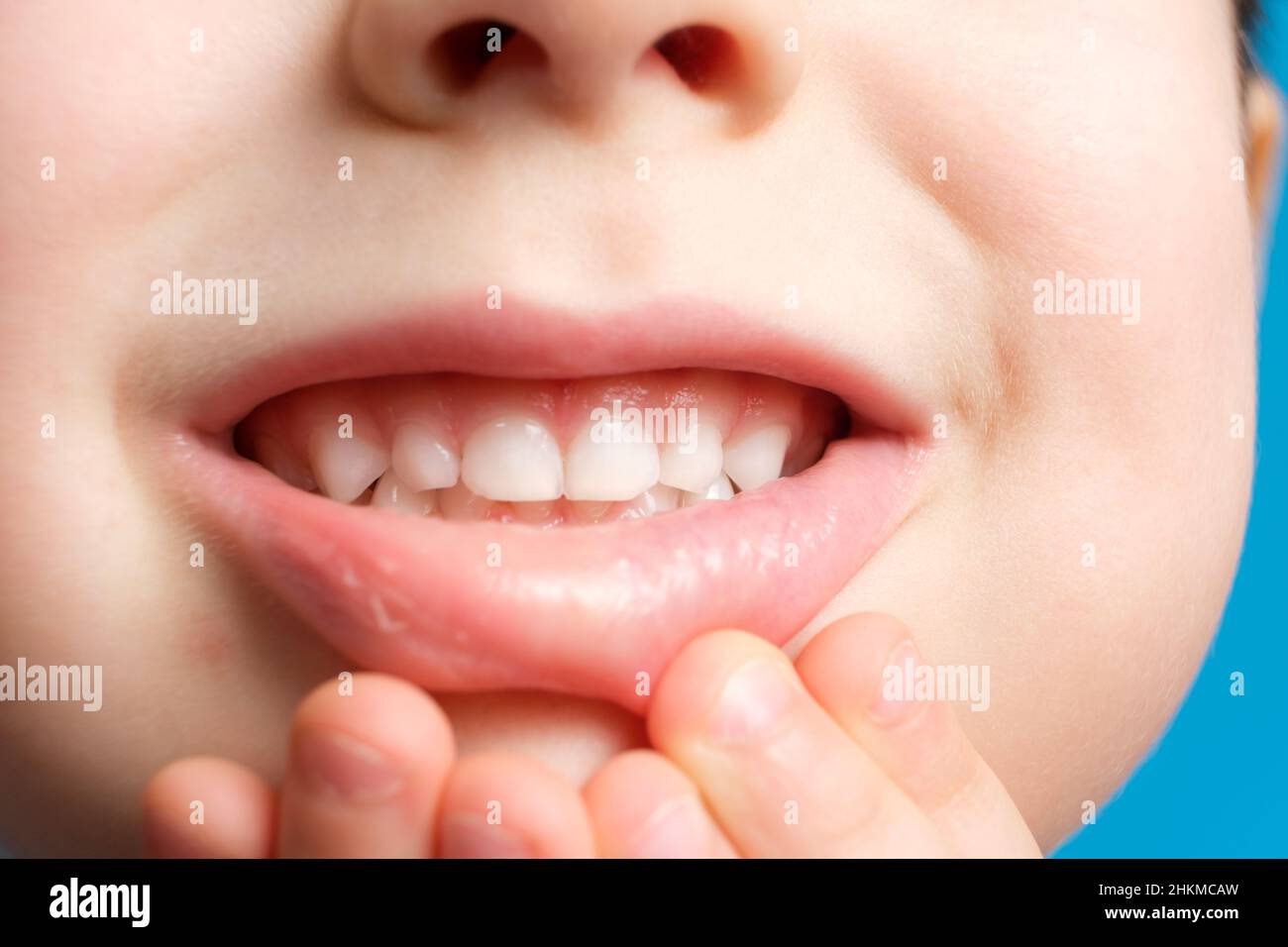 Children's milk teeth in a child, open mouth, closeup. Pediatric